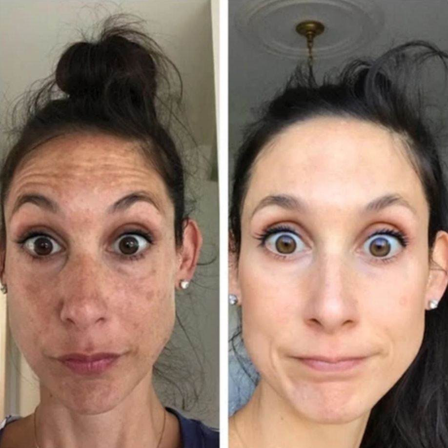 melasma-treatment-before-after